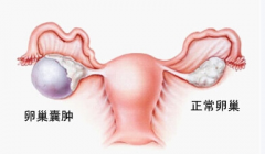 卵巢囊肿的危害有哪些