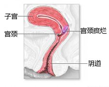 导致宫颈糜烂发生的原因有哪些