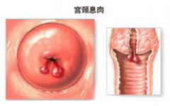 宫颈息肉治疗的最佳时间