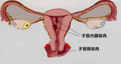 导致宫颈息肉发生的原因有哪些