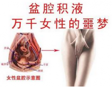 女性患上盆腔积液的原因