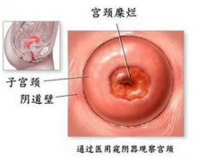 宫颈糜烂会导致不孕吗